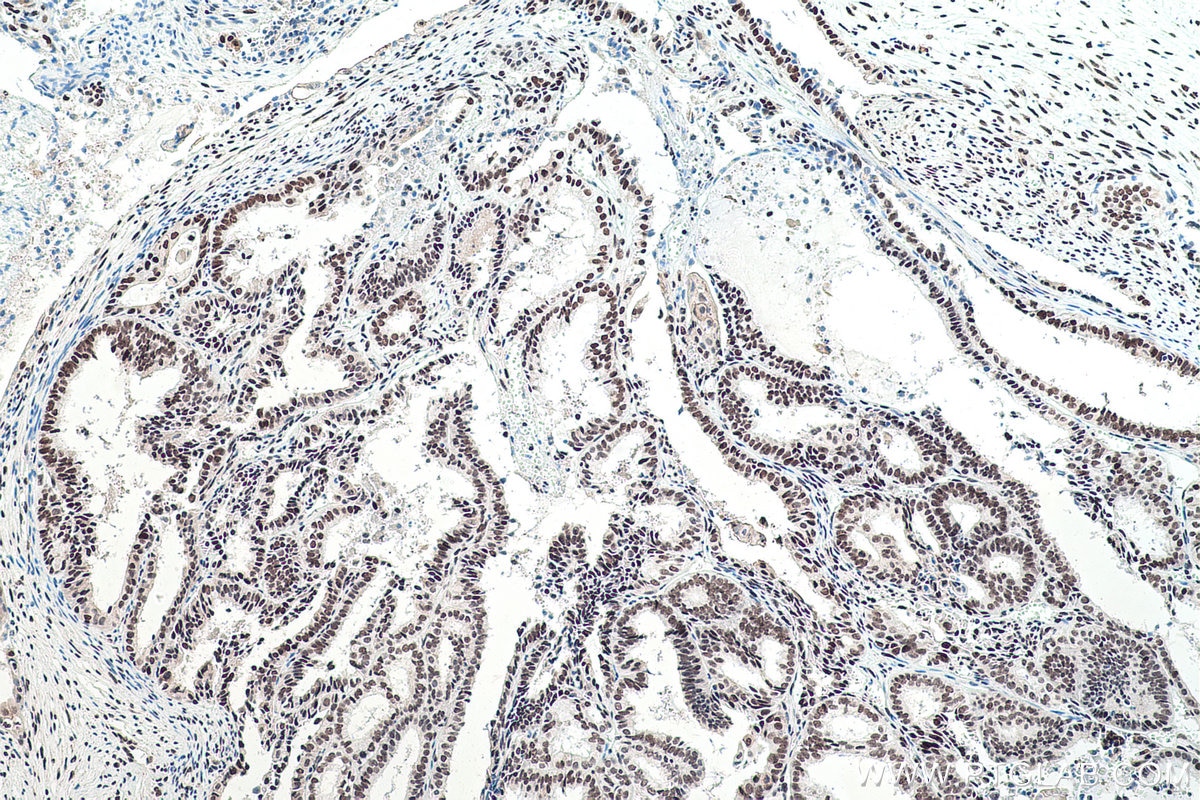 Immunohistochemistry (IHC) staining of human ovary tumor tissue using FUS/TLS Polyclonal antibody (11570-1-AP)