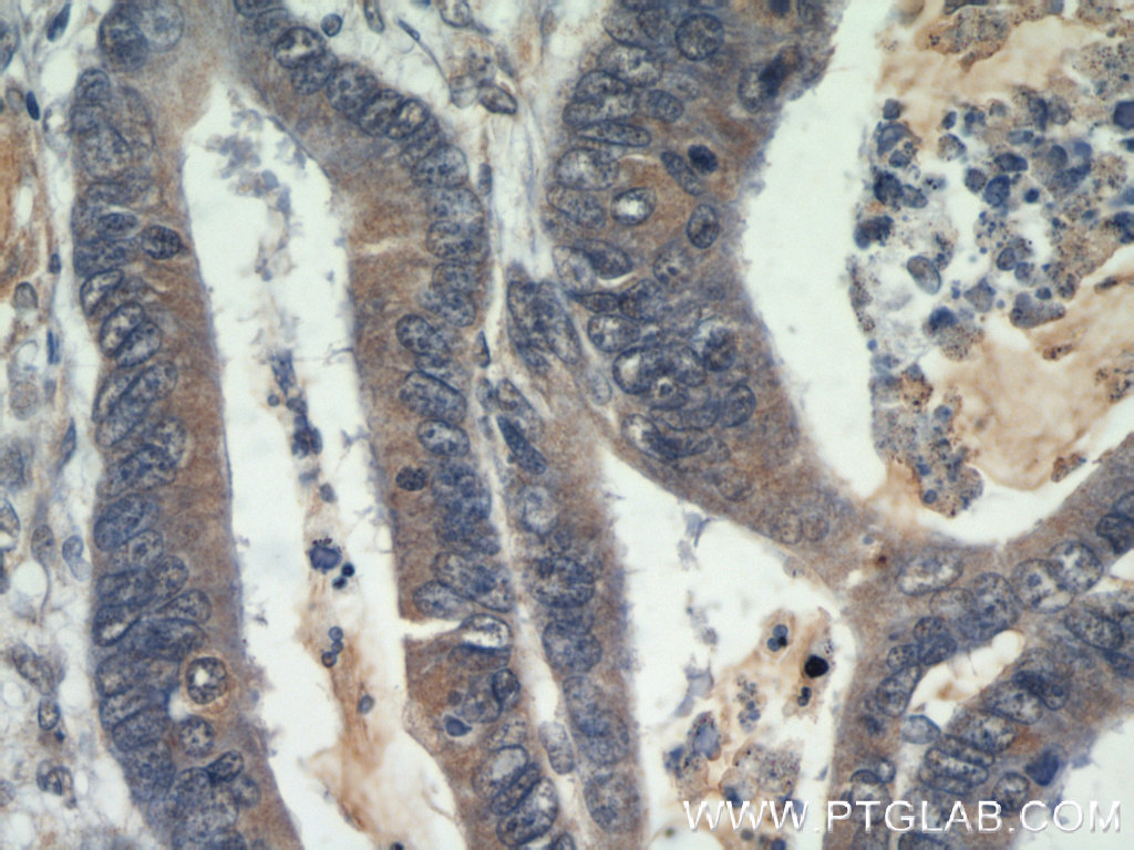 IHC of paraffin-embedded human colon cancer using Beclin 1 antibody (11306-1-AP) at a dilution of 1:50; under 40x