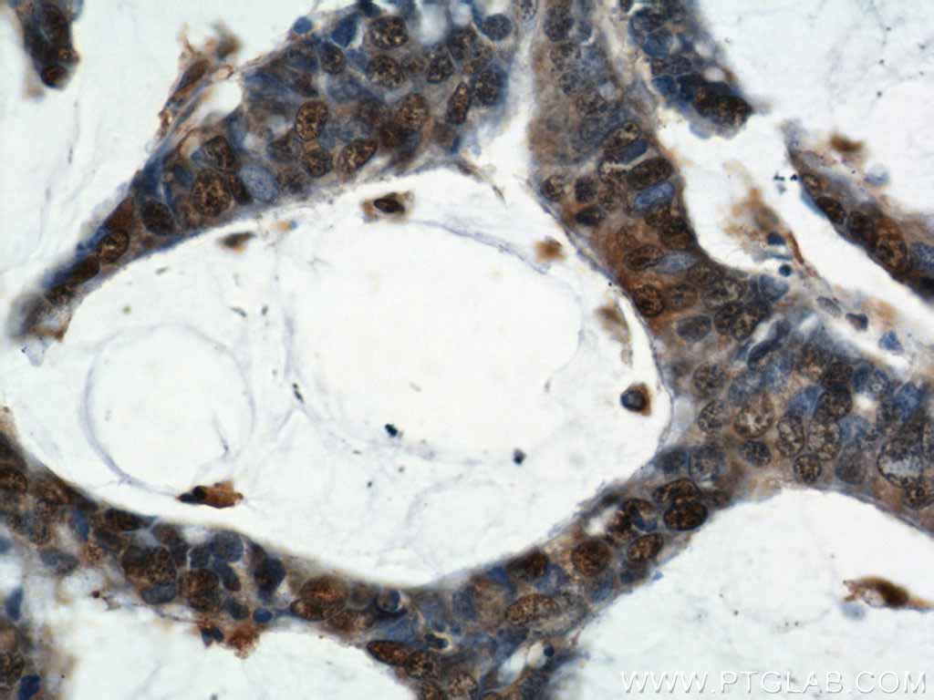 Immunohistochemical of paraffin-embedded human colon cancer using 11204-1-AP(ENO1 antibody) at dilution of 1:50 (under 40x lens)