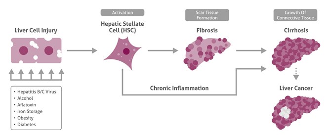 The stages of liver disease and liver cancer