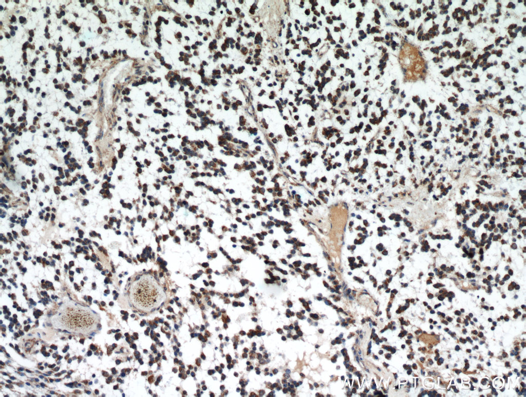 Immunohistochemical of paraffin-embedded human gliomas using IDH1 antibody