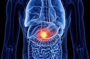 Pancreatic Cancer | Proteintech Group