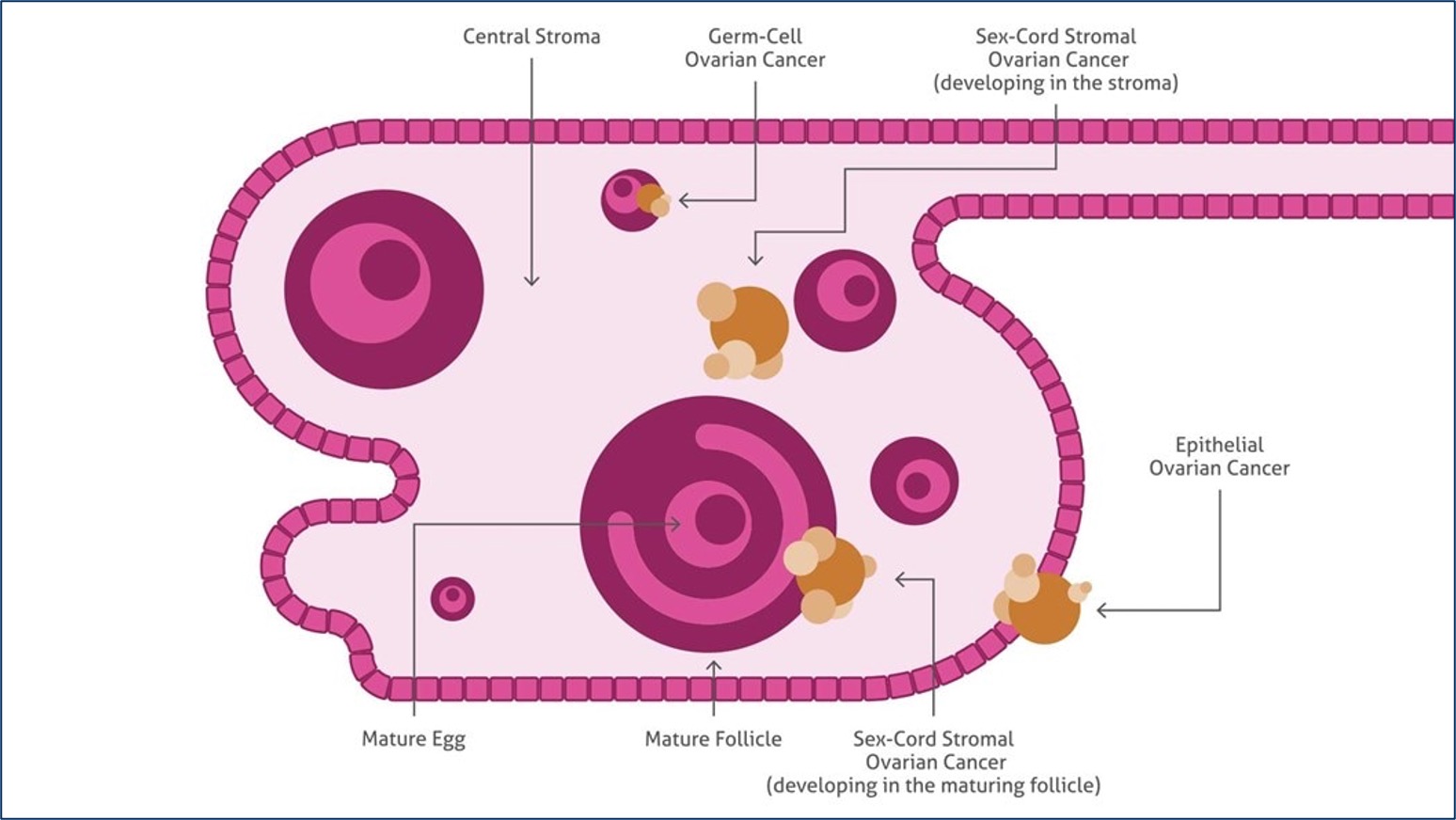 Schema of the ovary showing the histopathological types of ovarian cancer