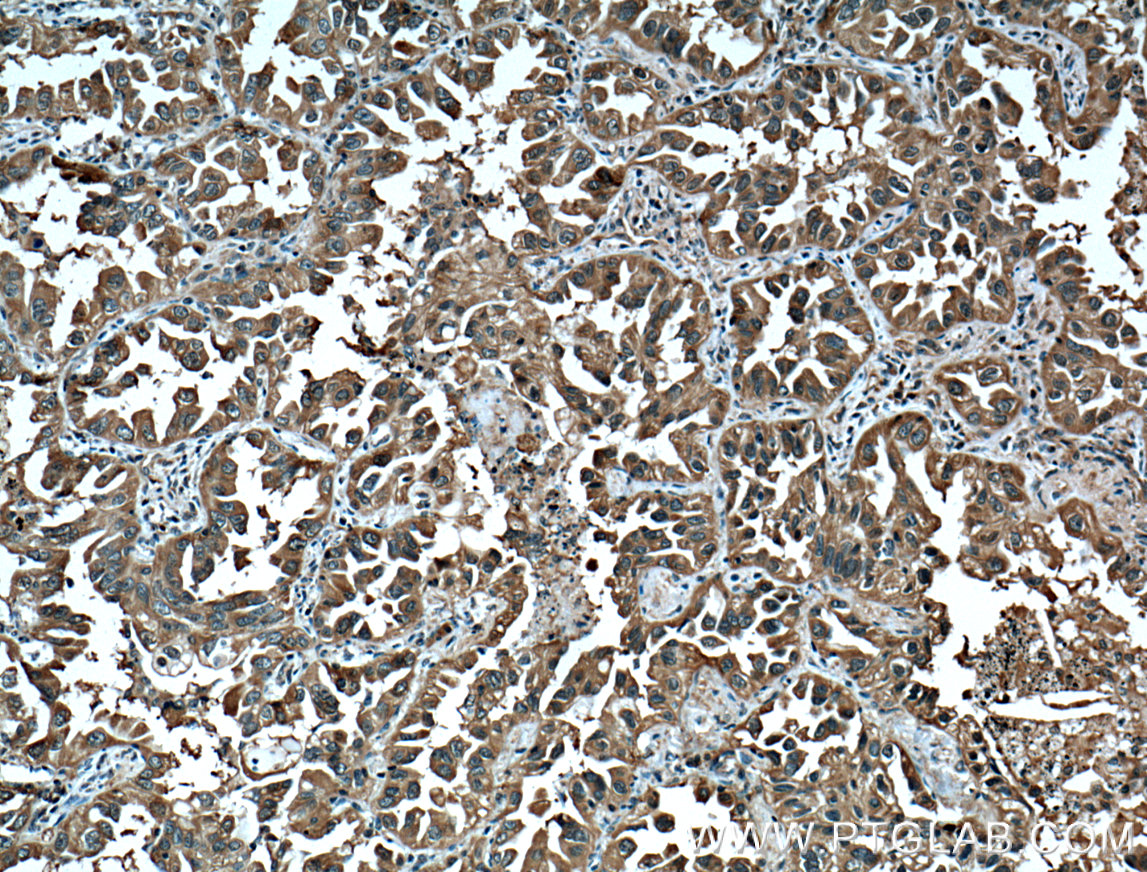 Immunohistochemistry (IHC) staining of human lung cancer tissue using 14-3-3 Monoclonal antibody (66061-1-Ig)