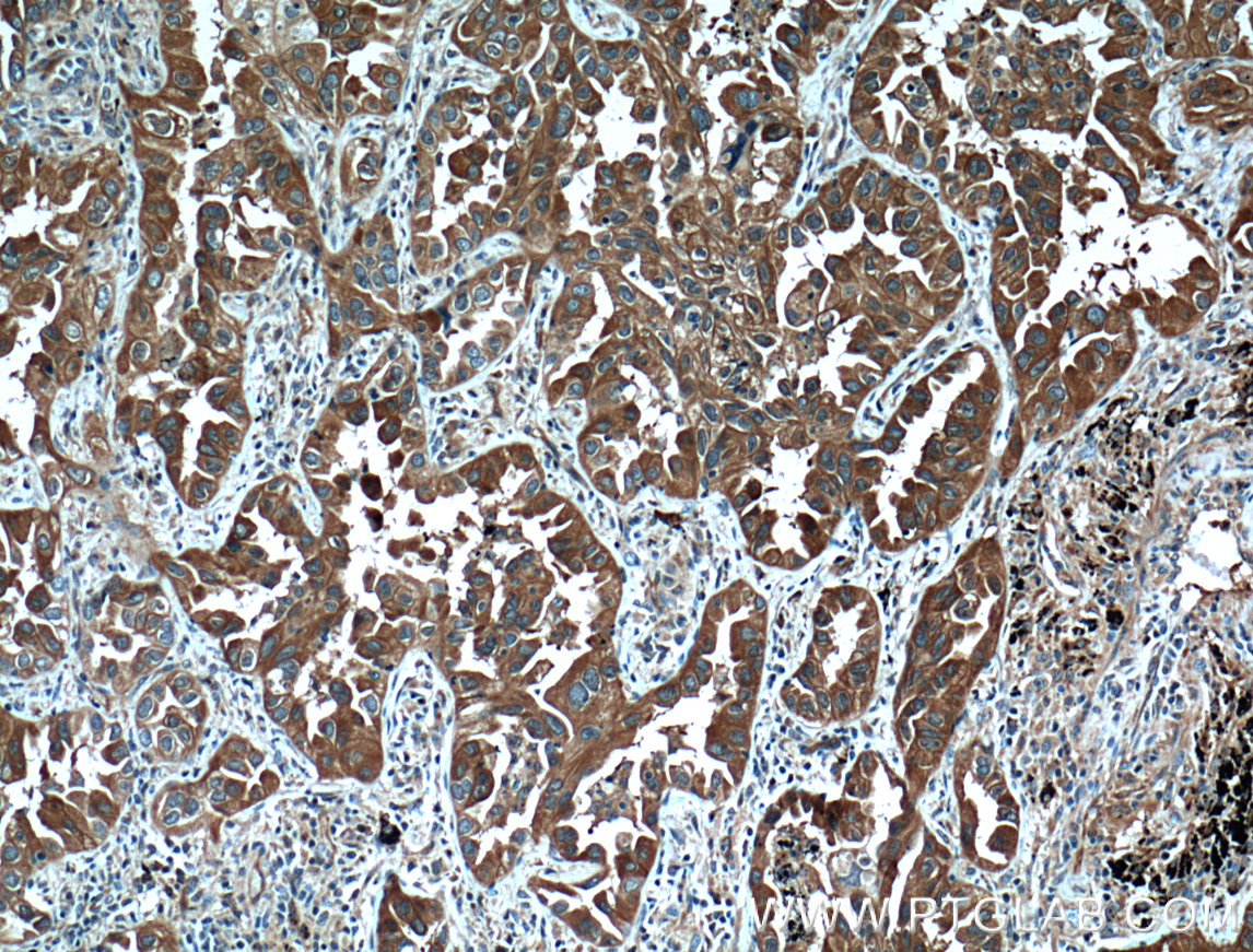 Immunohistochemistry (IHC) staining of human lung cancer tissue using 14-3-3 GAMMA-Specific Polyclonal antibody (12381-1-AP)