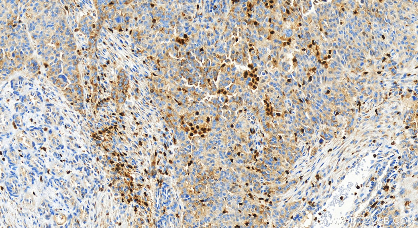 Immunohistochemistry (IHC) staining of human ovarian  cancer using 5 Lipoxygenase Recombinant antibody (83794-4-RR)