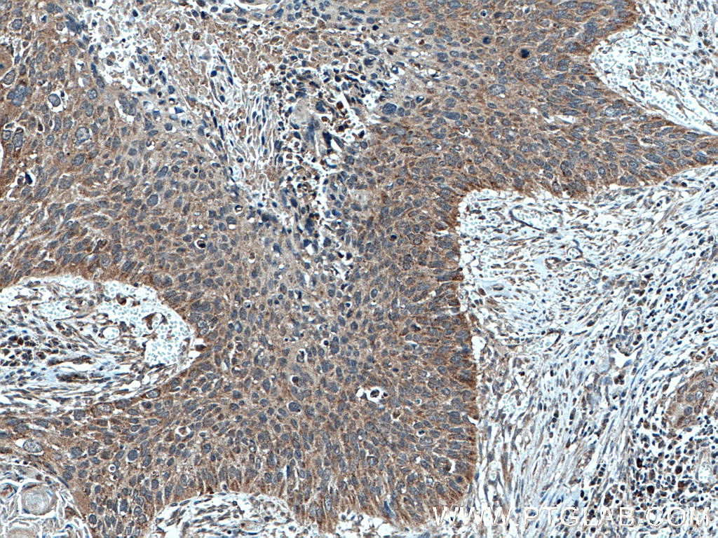 Immunohistochemistry (IHC) staining of human cervical cancer tissue using A4GALT Polyclonal antibody (12392-1-AP)