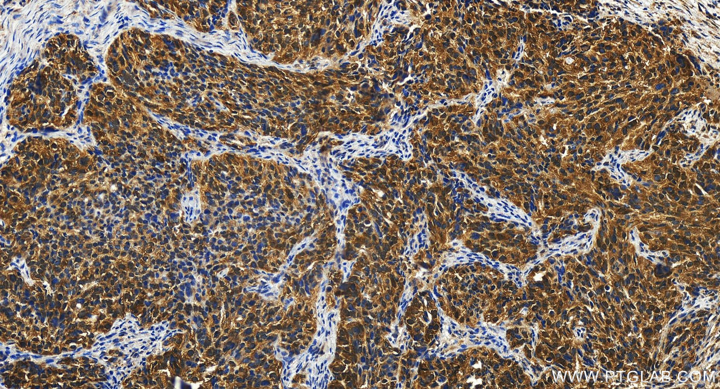 Immunohistochemistry (IHC) staining of human ovary cancer tissue using AACS Polyclonal antibody (13815-1-AP)