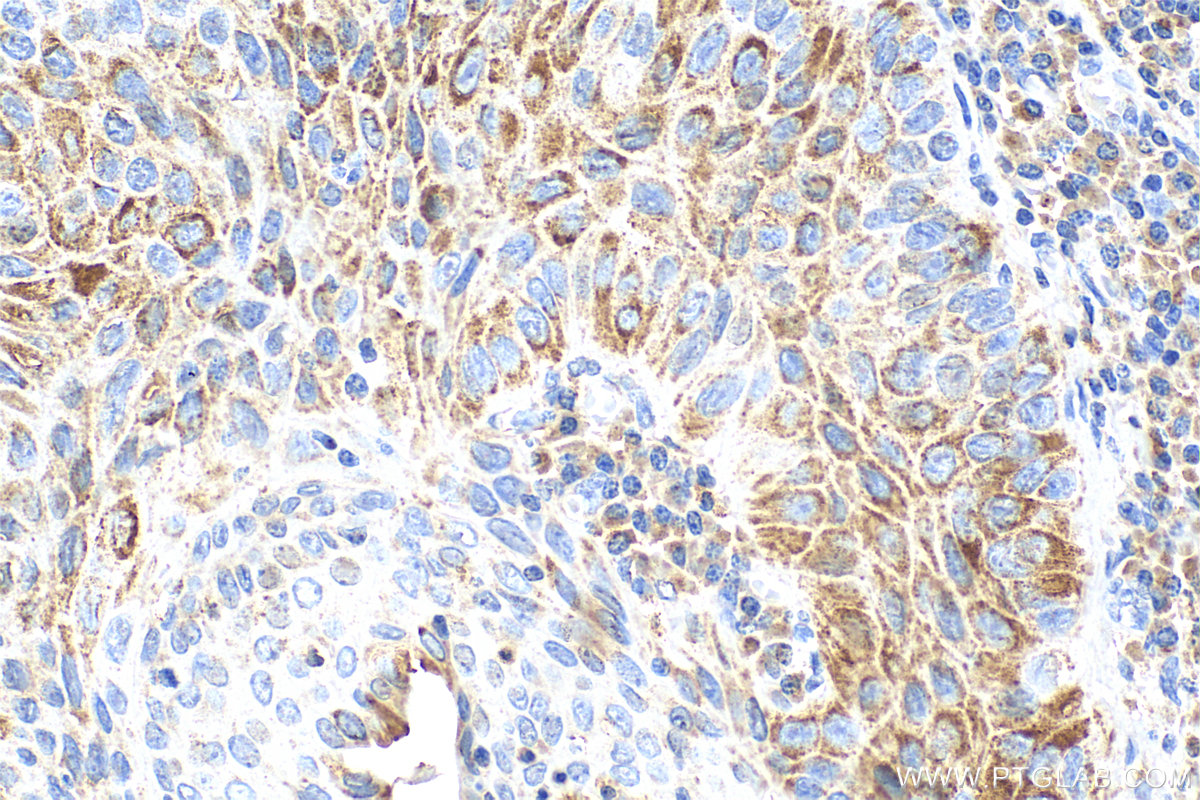 Immunohistochemistry (IHC) staining of Customer Sample customer using ABAT Polyclonal antibody (11349-1-AP)