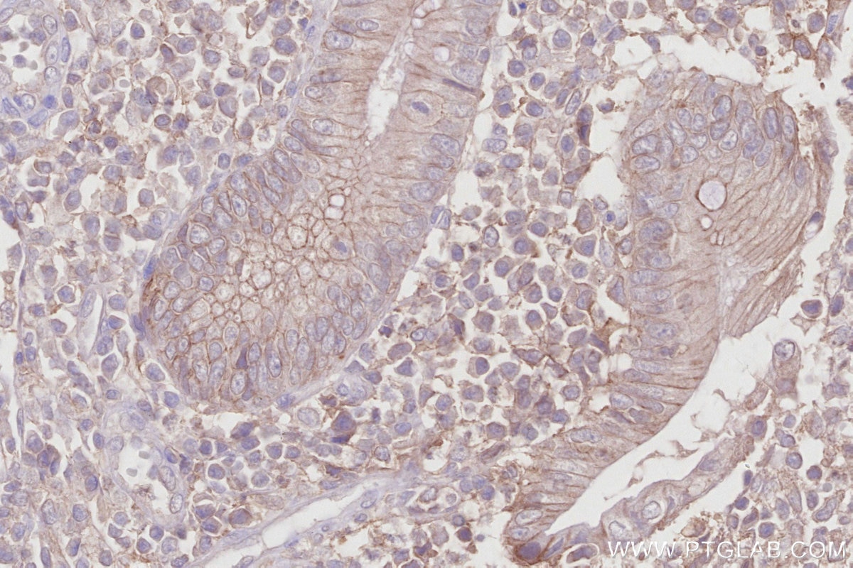 Immunohistochemistry (IHC) staining of human appendicitis tissue using MRP1 Monoclonal antibody (67228-1-Ig)