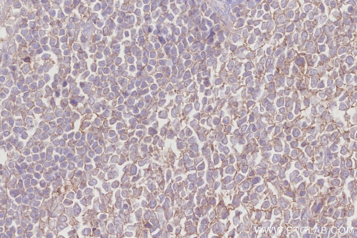 Immunohistochemistry (IHC) staining of human appendicitis tissue using MRP1 Monoclonal antibody (67228-1-Ig)