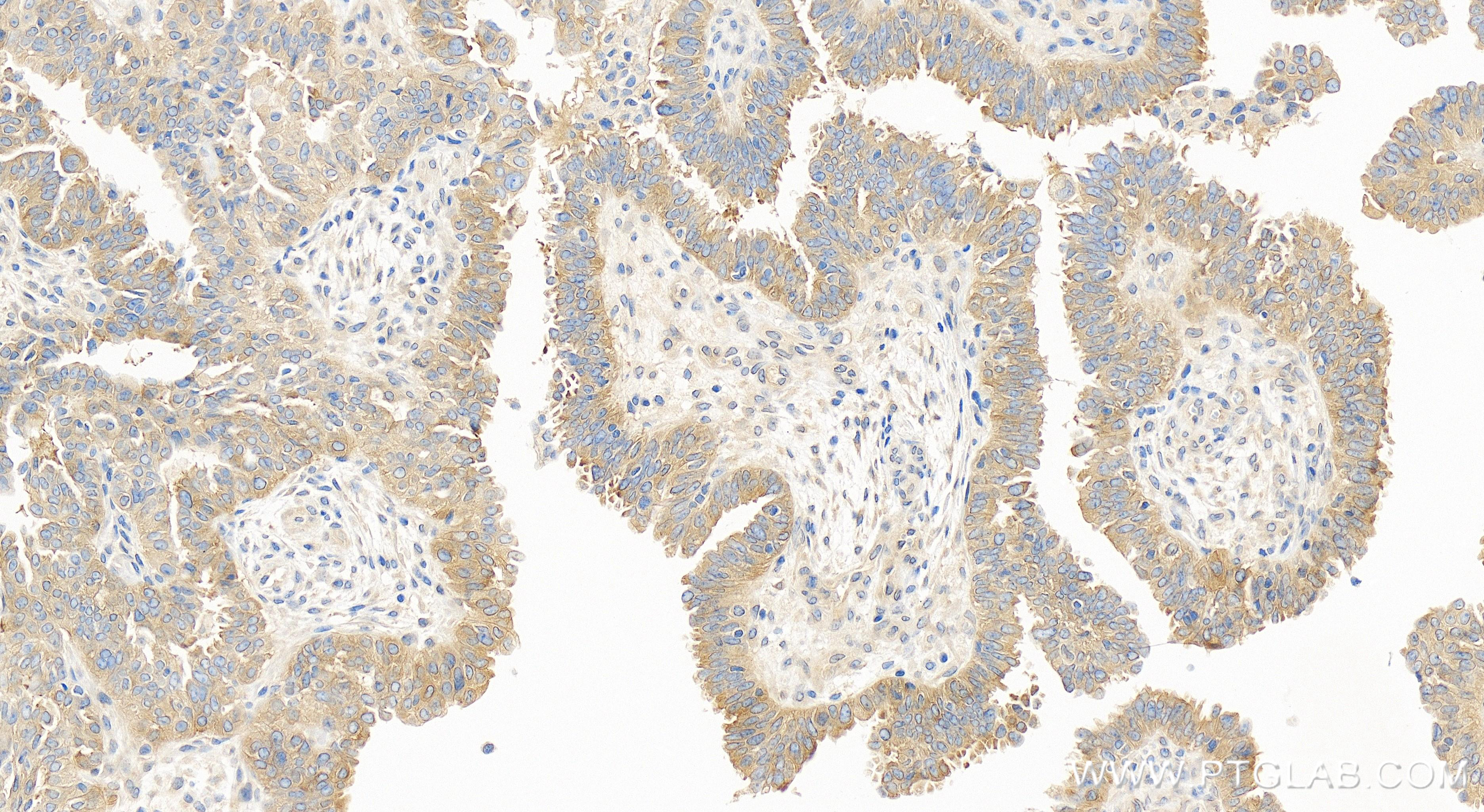 Immunohistochemistry (IHC) staining of human ovary cancer tissue using ABCC5 Recombinant antibody (84204-5-RR)