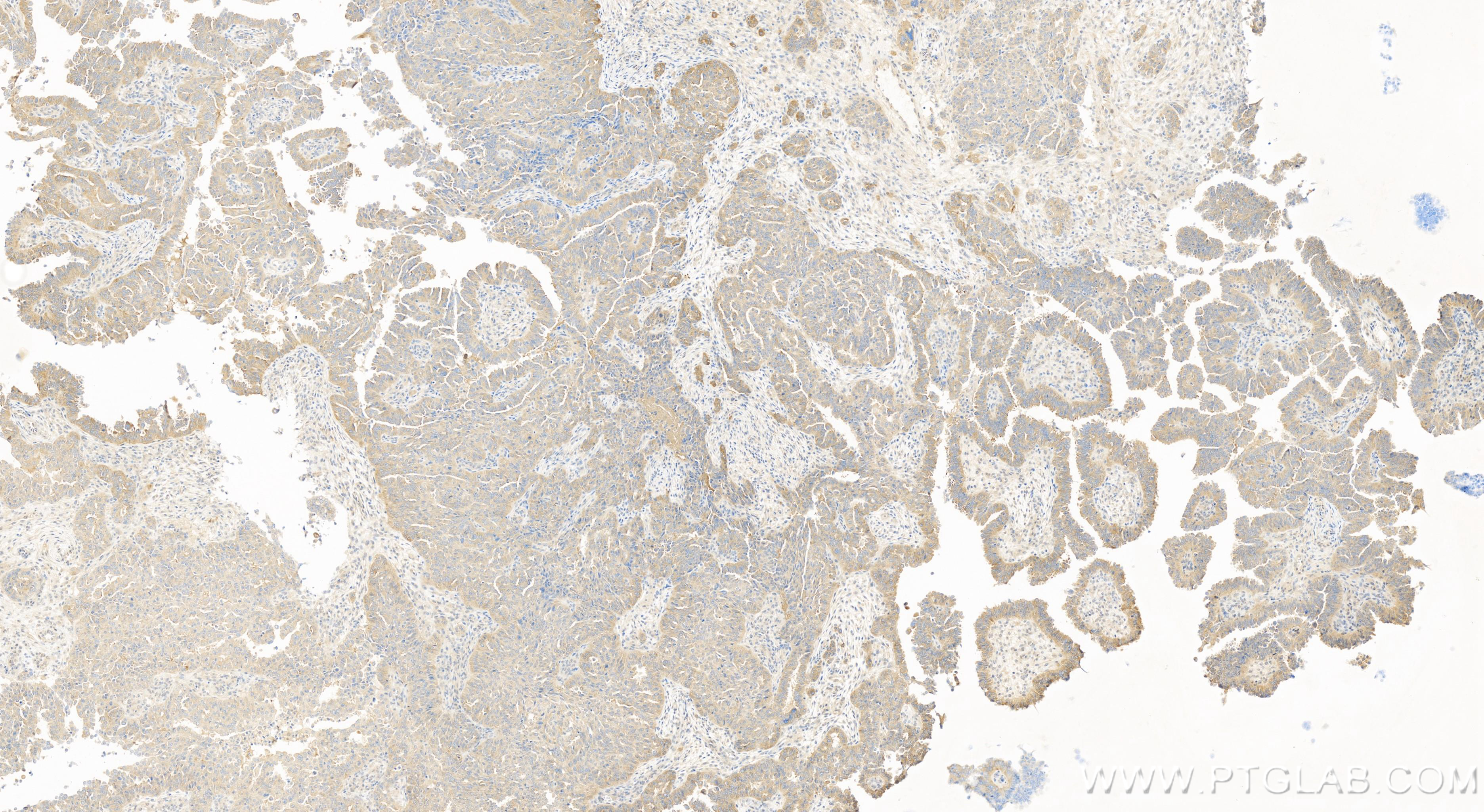 Immunohistochemistry (IHC) staining of human ovary cancer tissue using ABCC5 Recombinant antibody (84204-5-RR)