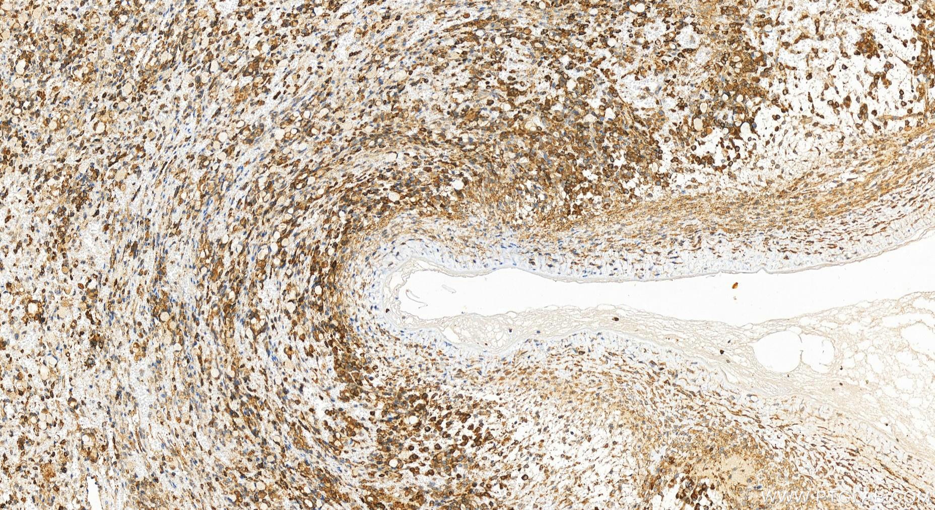 Immunohistochemistry (IHC) staining of human ovary cancer tissue using ABCD1 Polyclonal antibody (18138-1-AP)