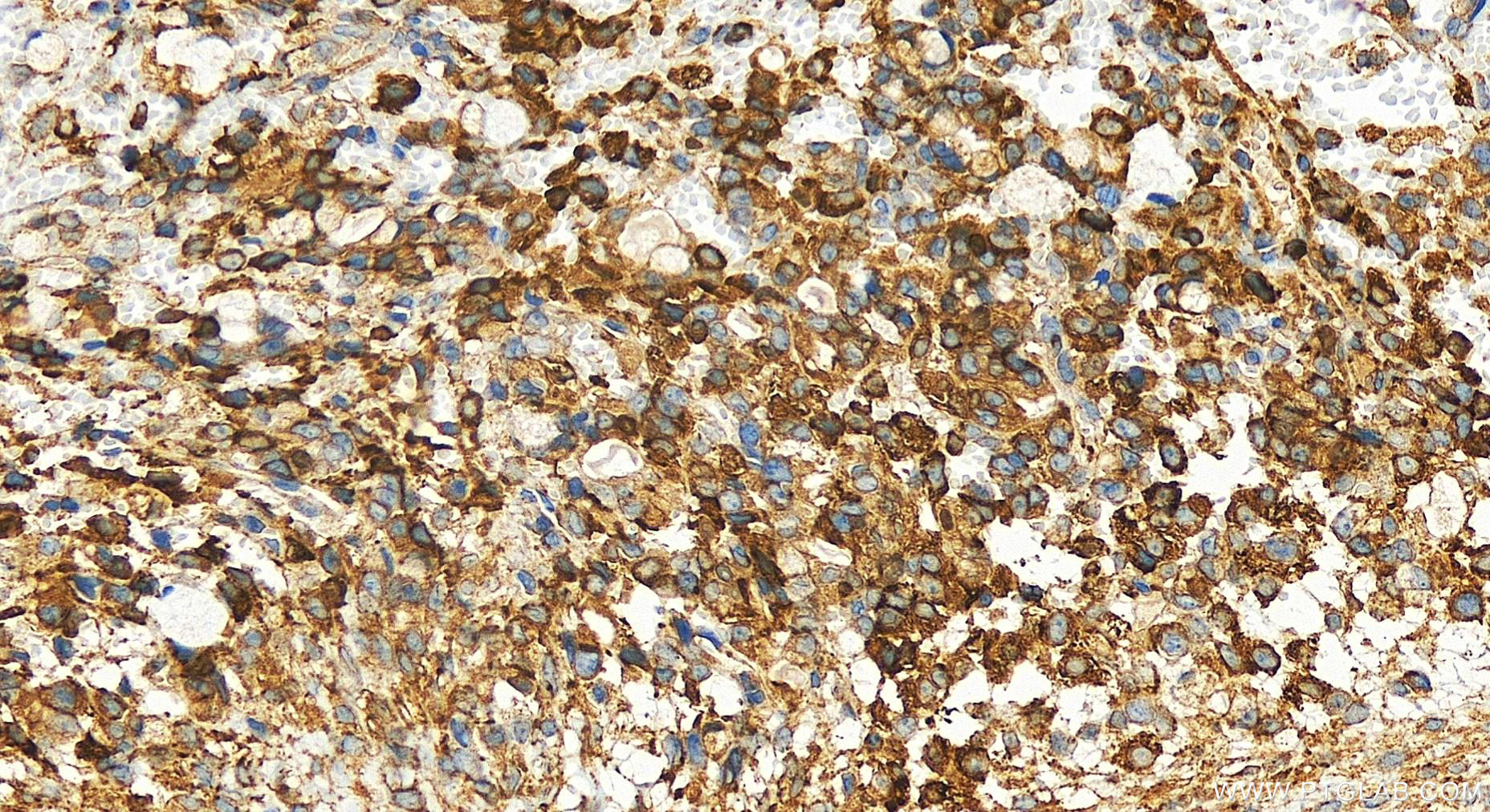 Immunohistochemistry (IHC) staining of human ovary cancer tissue using ABCD1 Polyclonal antibody (18138-1-AP)