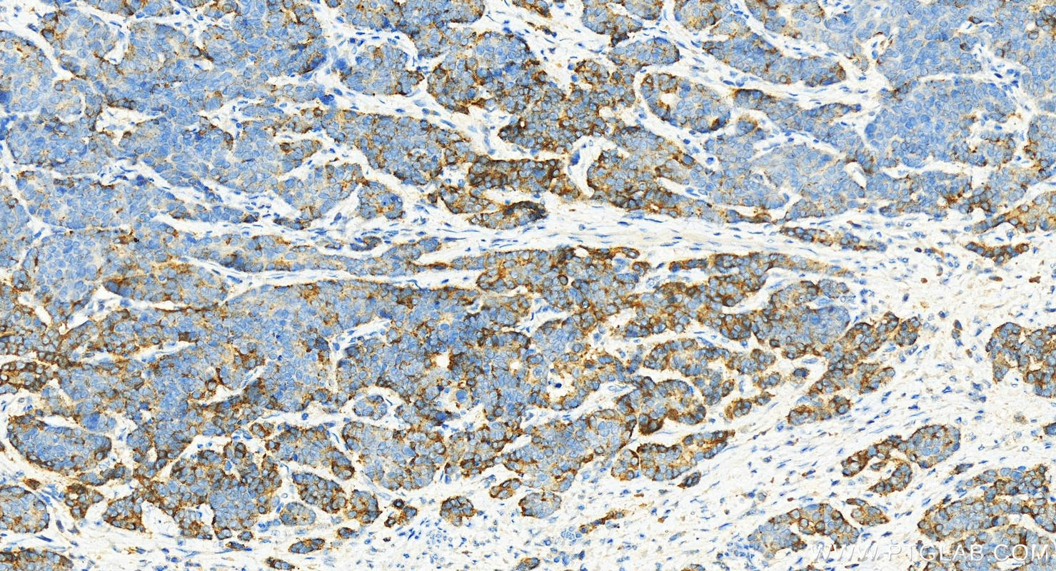 Immunohistochemistry (IHC) staining of human stomach cancer tissue using ABCF1 Polyclonal antibody (13950-1-AP)