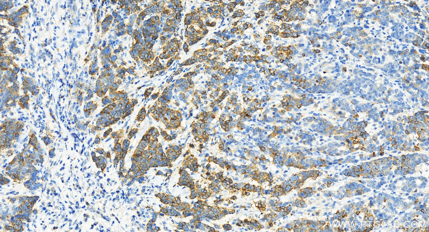 Immunohistochemistry (IHC) staining of human stomach cancer tissue using ABCF1 Polyclonal antibody (13950-1-AP)