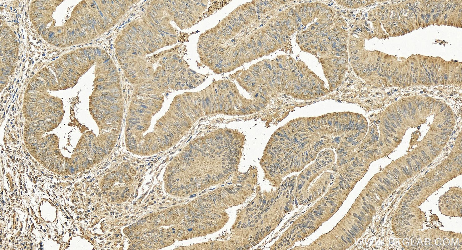 Immunohistochemistry (IHC) staining of human colon cancer tissue using ABCF2 Polyclonal antibody (10226-1-AP)