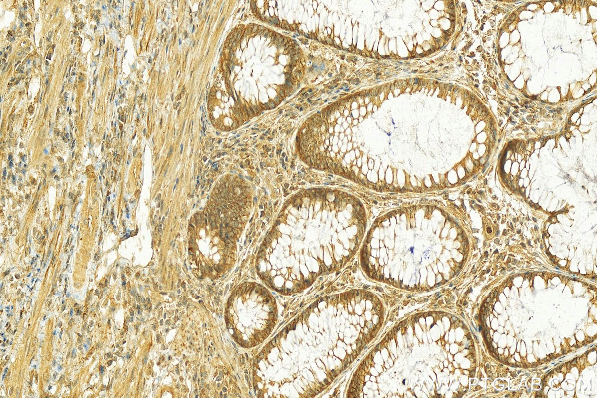 Immunohistochemistry (IHC) staining of human colon cancer tissue using ABP1 Polyclonal antibody (16338-1-AP)