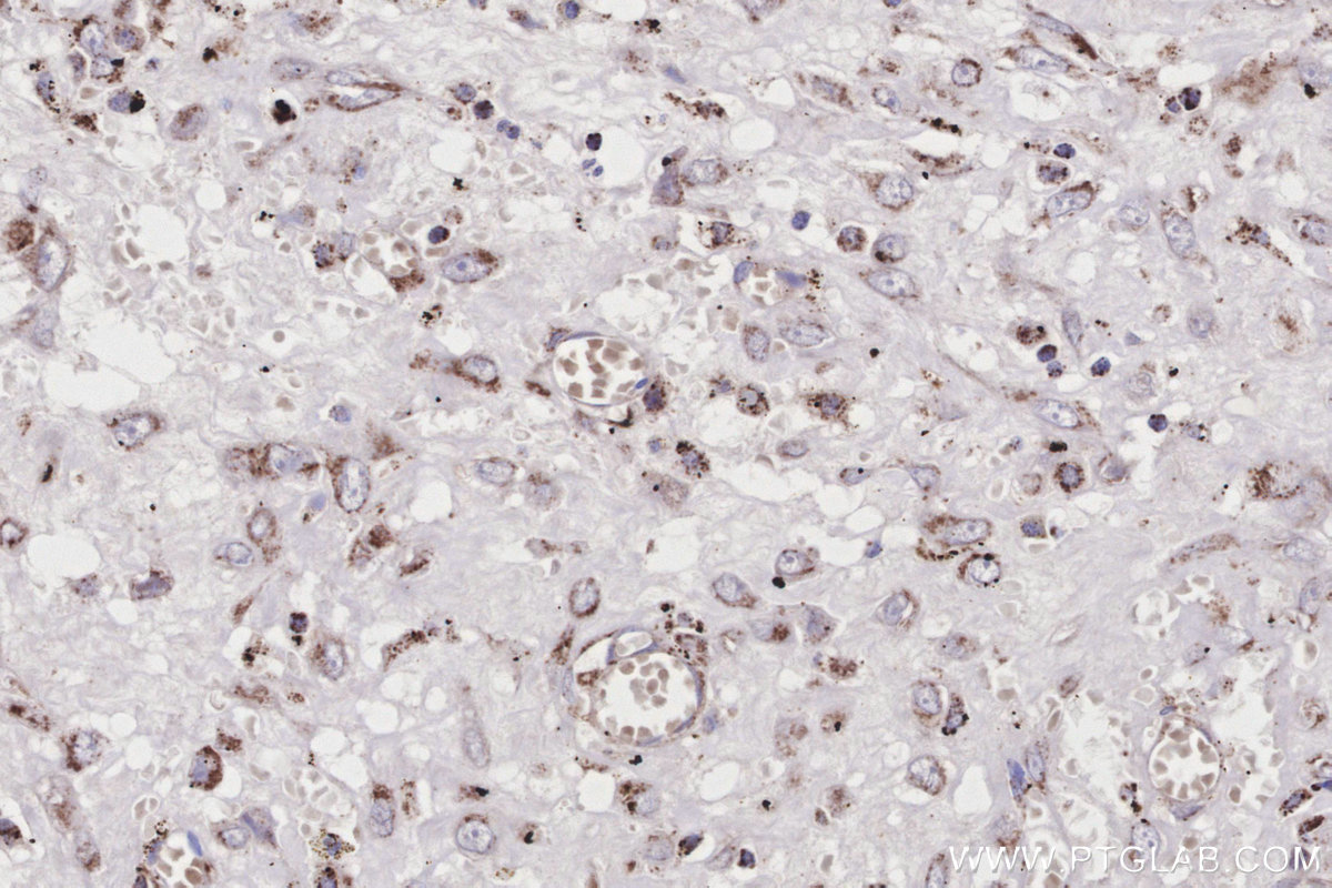 Immunohistochemistry (IHC) staining of human colon cancer tissue using ACADS Polyclonal antibody (16623-1-AP)