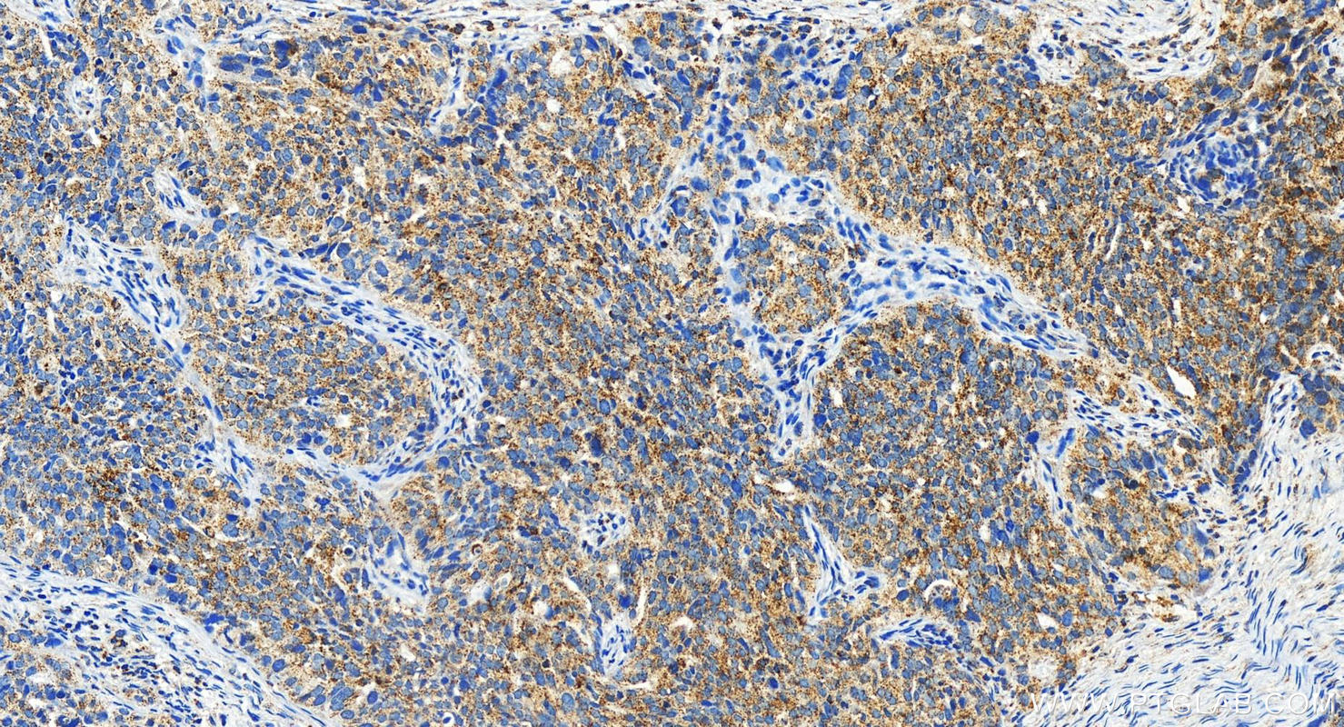 Immunohistochemistry (IHC) staining of human ovary cancer tissue using ACBD5 Polyclonal antibody (21080-1-AP)