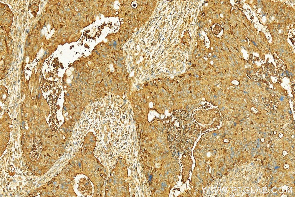 Immunohistochemistry (IHC) staining of human colon cancer tissue using ACE2 Polyclonal antibody (28868-1-AP)