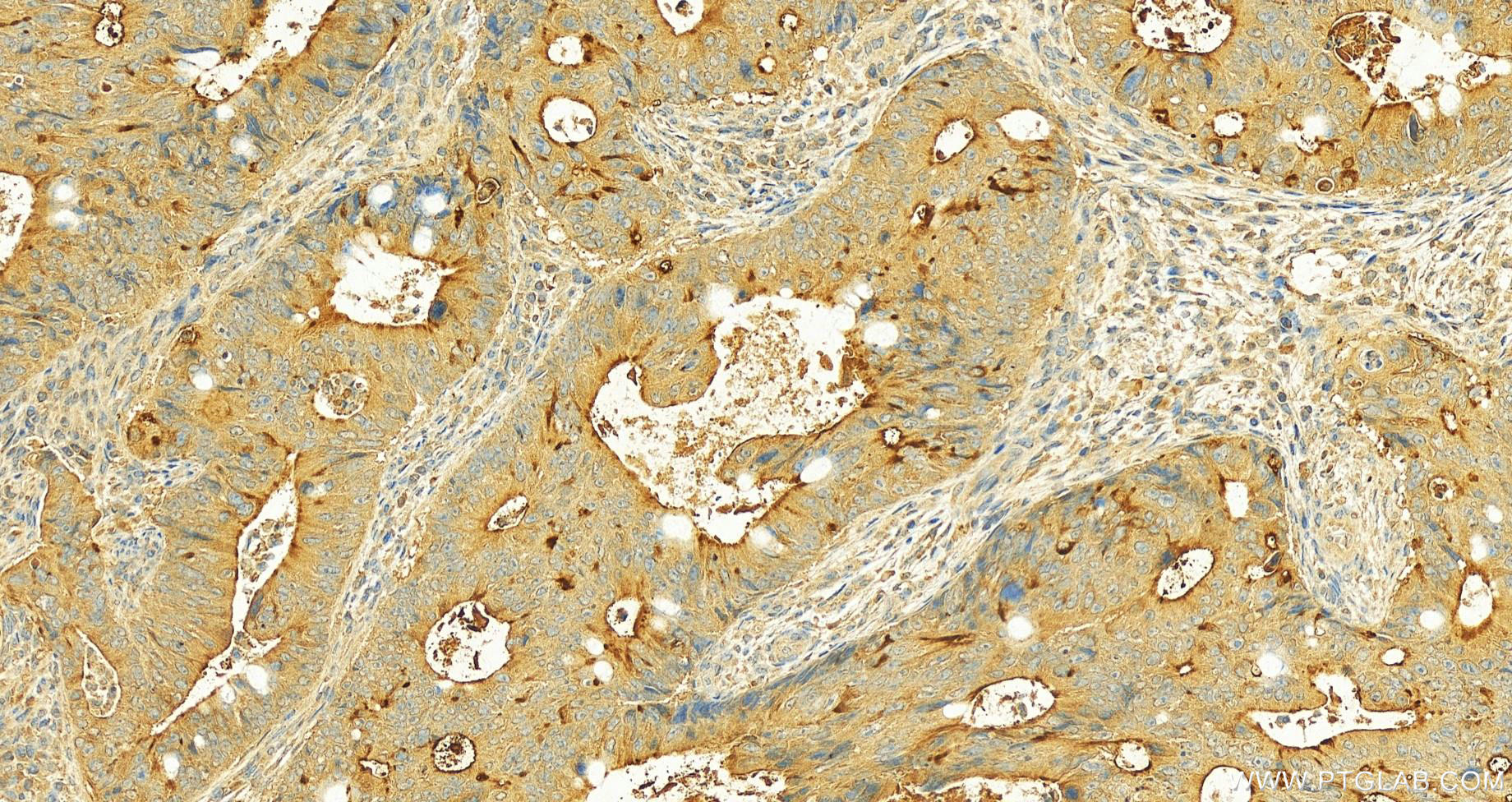 Immunohistochemistry (IHC) staining of human colon cancer tissue using ACE2 Monoclonal antibody (66699-1-Ig)