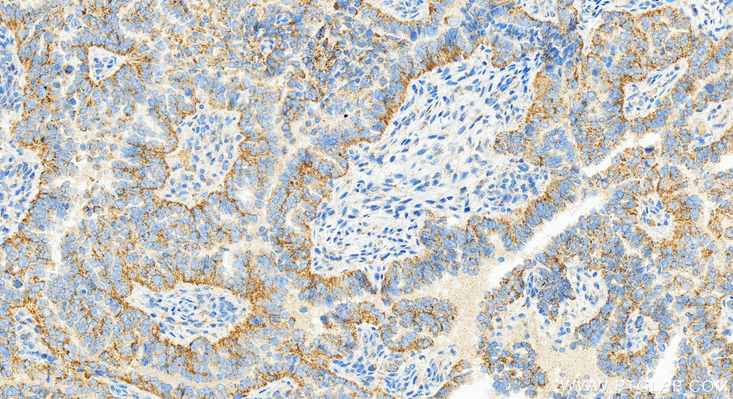 Immunohistochemistry (IHC) staining of human ovarian  cancer using ACOX1 Recombinant antibody (83731-1-RR)