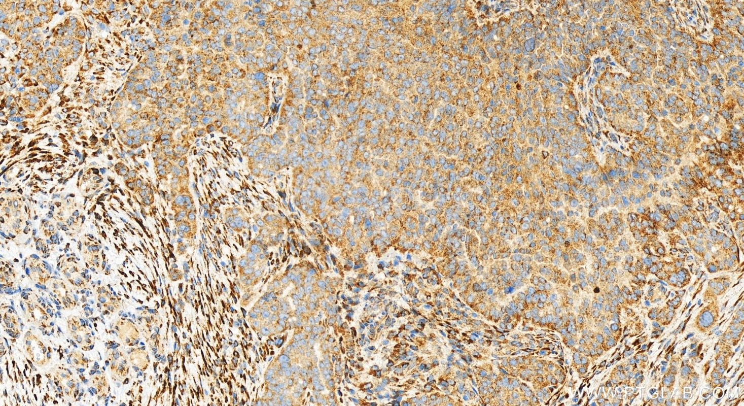 Immunohistochemistry (IHC) staining of human ovarian cancer using ACOX1 Recombinant monoclonal antibody (83731-2-RR)