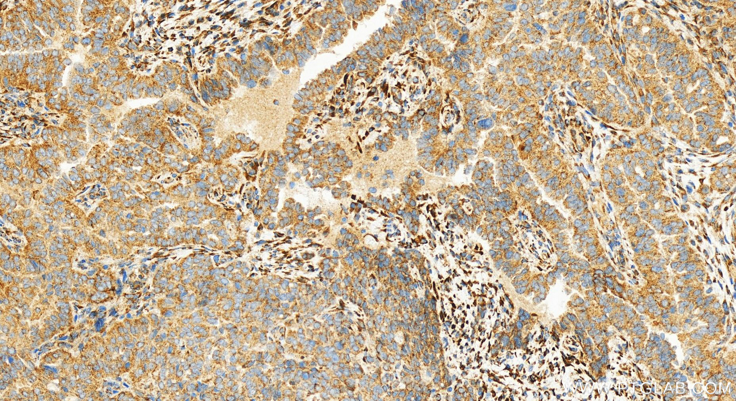 Immunohistochemistry (IHC) staining of human ovarian  cancer using ACOX1 Recombinant antibody (83731-2-RR)