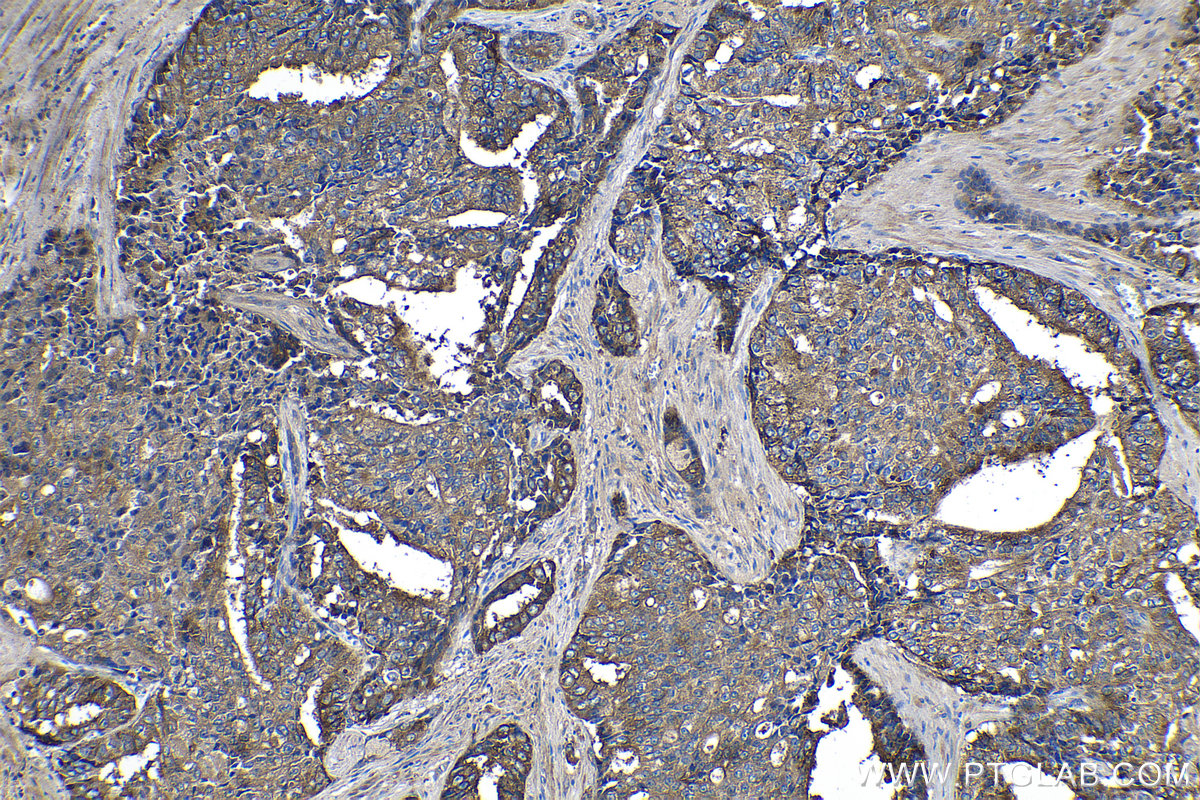 Immunohistochemistry (IHC) staining of human prostate hyperplasia tissue using ACPP Monoclonal antibody (60176-1-Ig)
