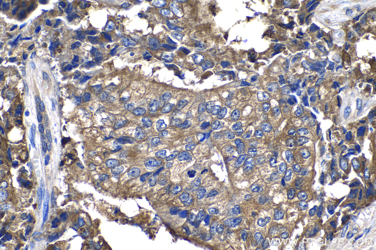 Immunohistochemistry (IHC) staining of human prostate hyperplasia tissue using ACPP Monoclonal antibody (60176-1-Ig)