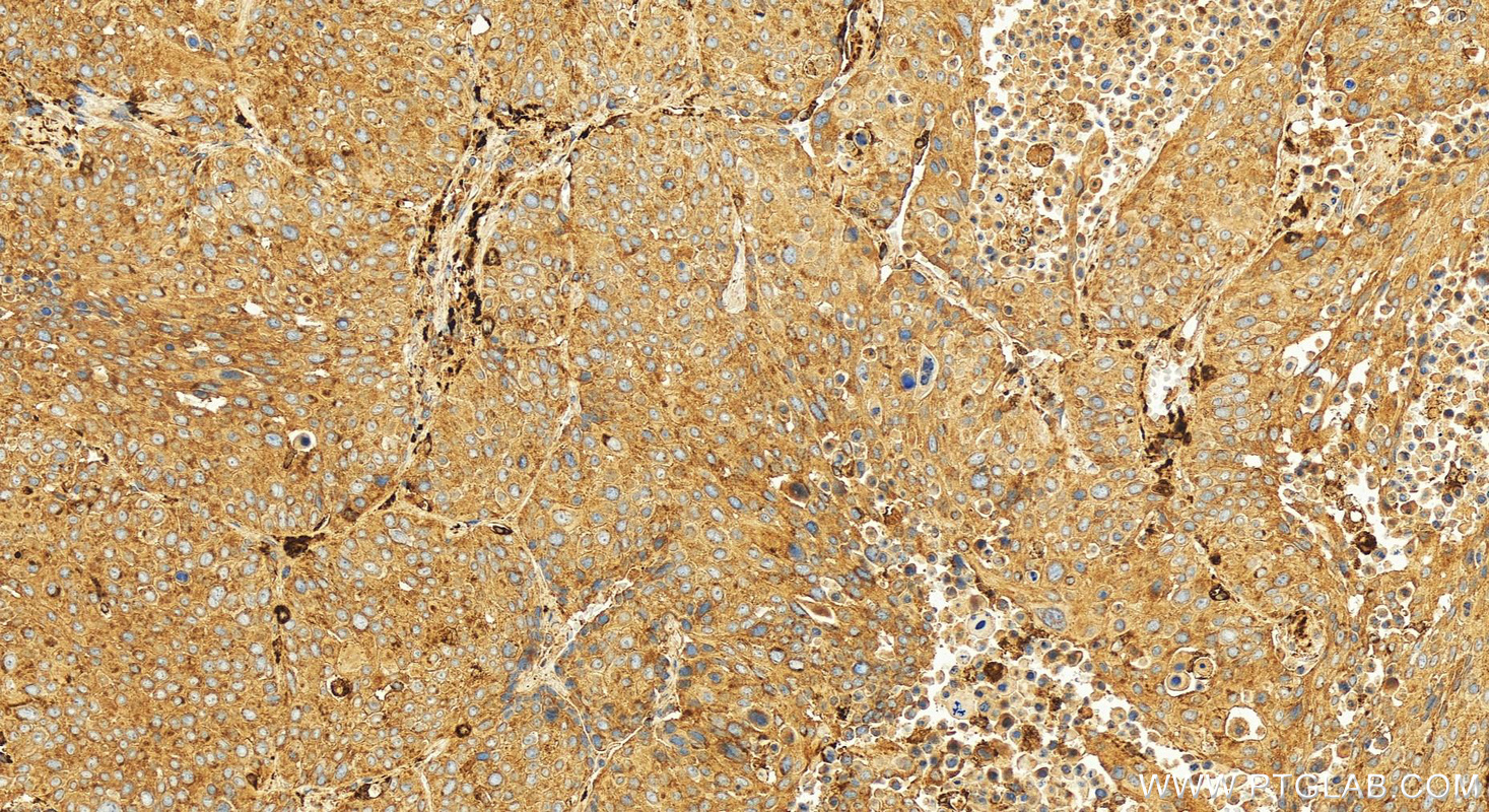 Immunohistochemistry (IHC) staining of human lung squamous cell carcinoma tissue using ACSL1 Polyclonal antibody (13989-1-AP)