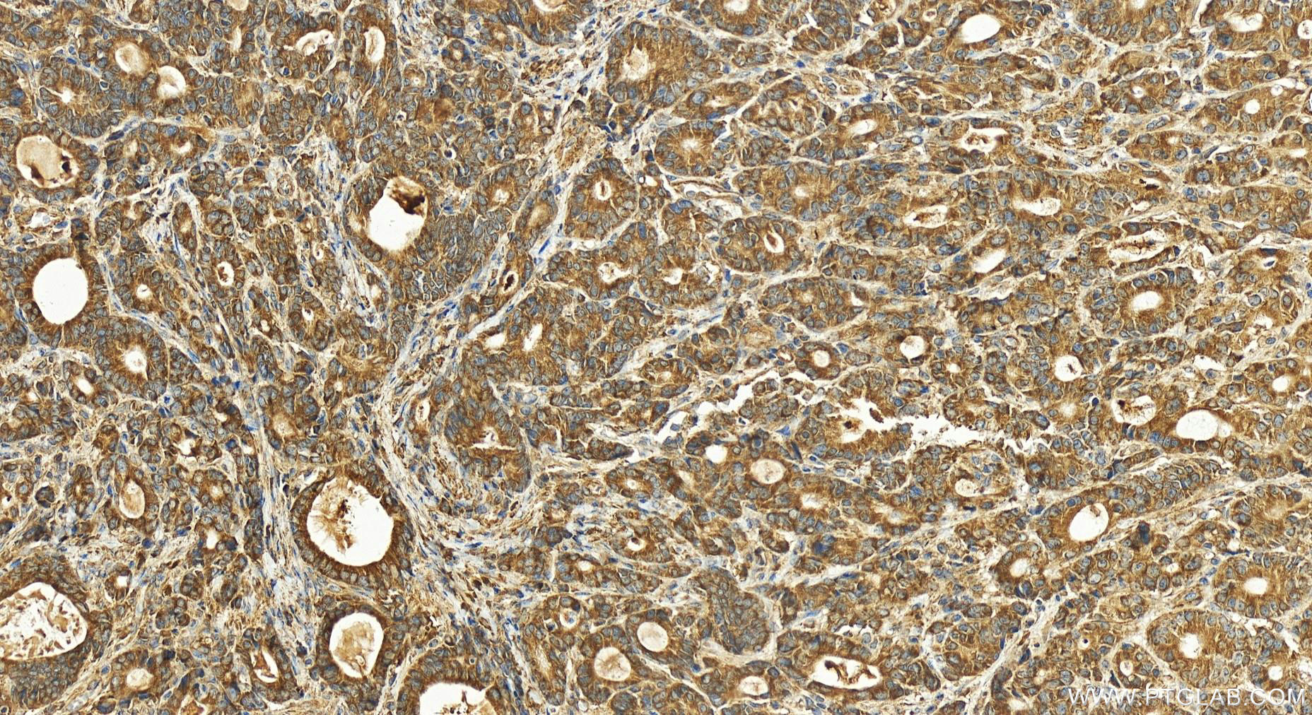 Immunohistochemistry (IHC) staining of human stomach cancer tissue using ACSL3 Polyclonal antibody (20710-1-AP)