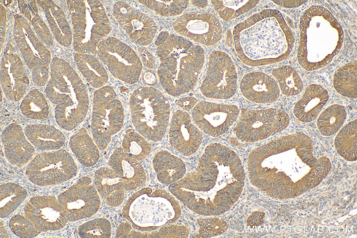 Immunohistochemistry (IHC) staining of human colon cancer tissue using ACSL5 Polyclonal antibody (15708-1-AP)