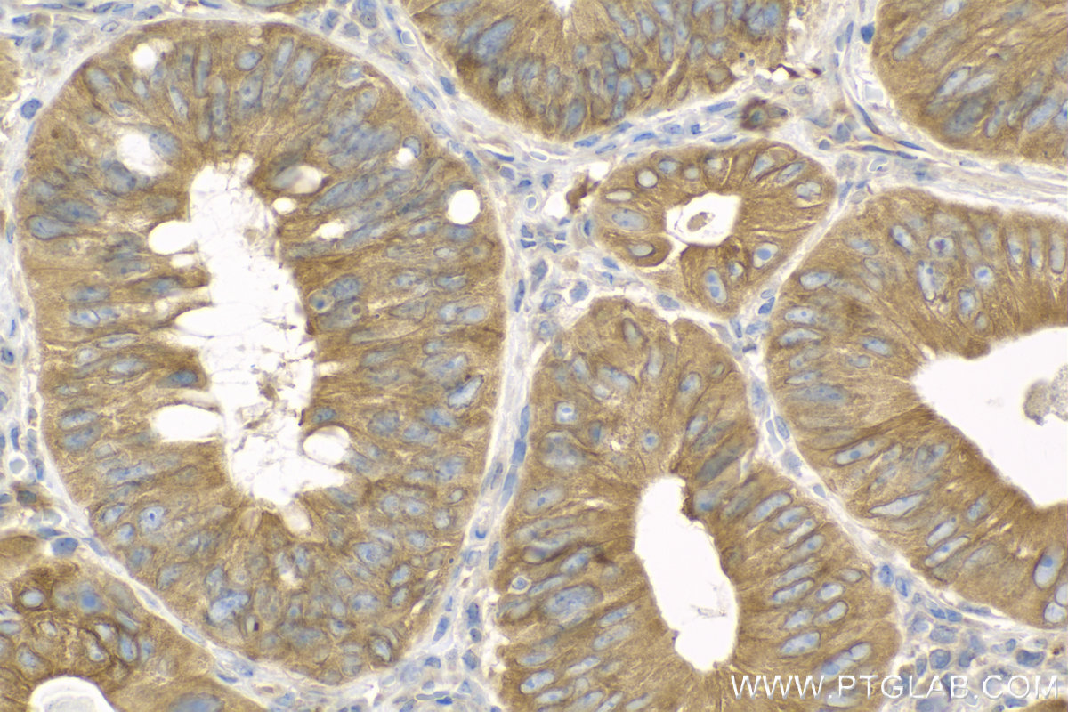 Immunohistochemistry (IHC) staining of human colon cancer tissue using ACSL5 Polyclonal antibody (15708-1-AP)