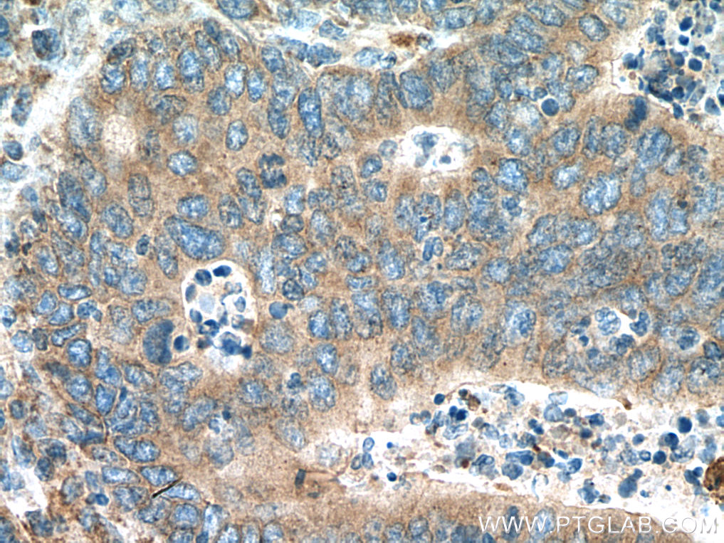 Immunohistochemistry (IHC) staining of human colon cancer tissue using ACSM3 Polyclonal antibody (10168-2-AP)