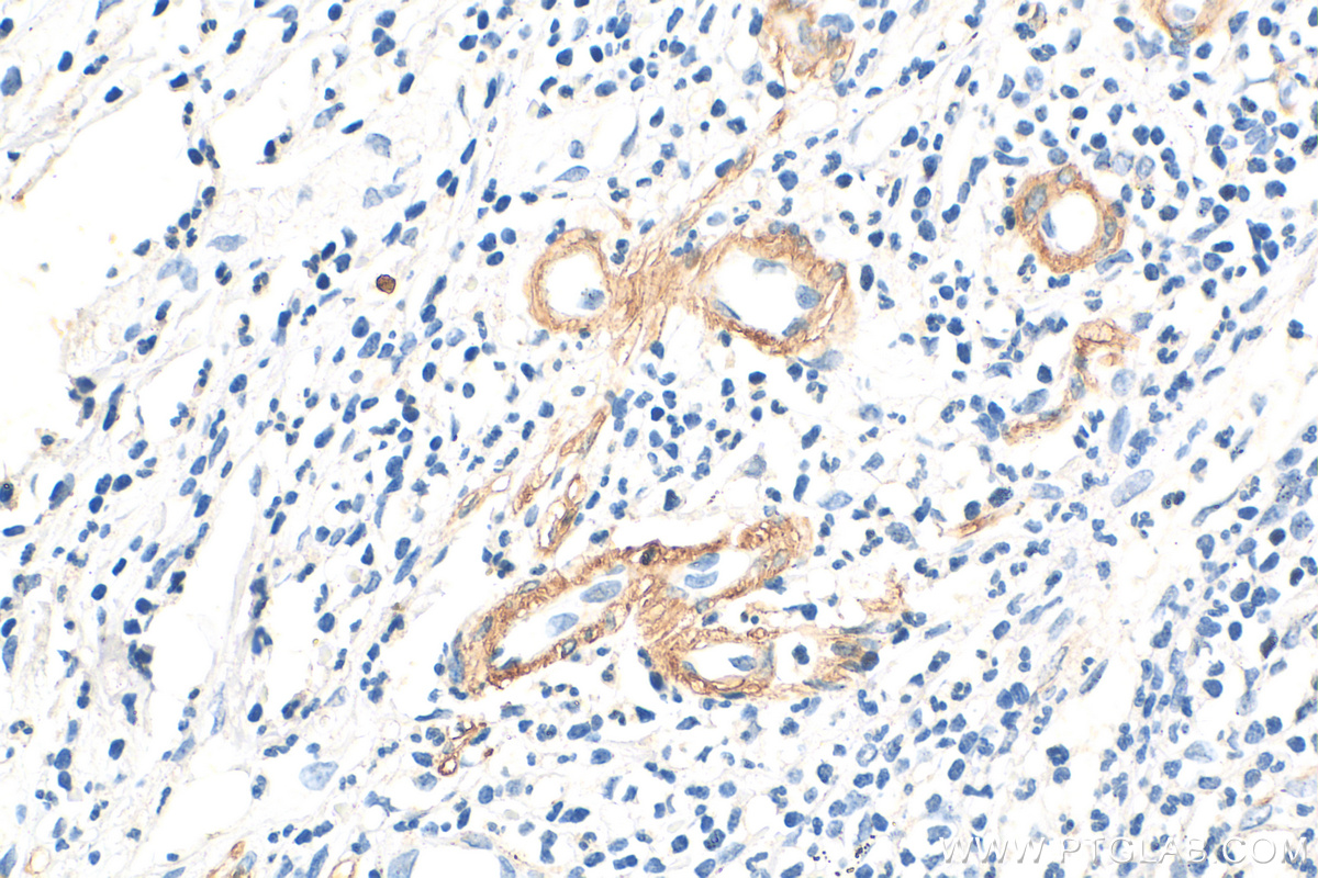 Immunohistochemistry (IHC) staining of human appendicitis tissue using smooth muscle actin Polyclonal antibody (14395-1-AP)