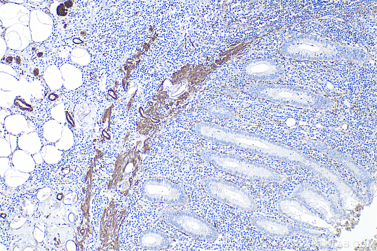 Immunohistochemistry (IHC) staining of human appendicitis tissue using Alpha smooth muscle actin Polyclonal antibody (14395-1-AP)
