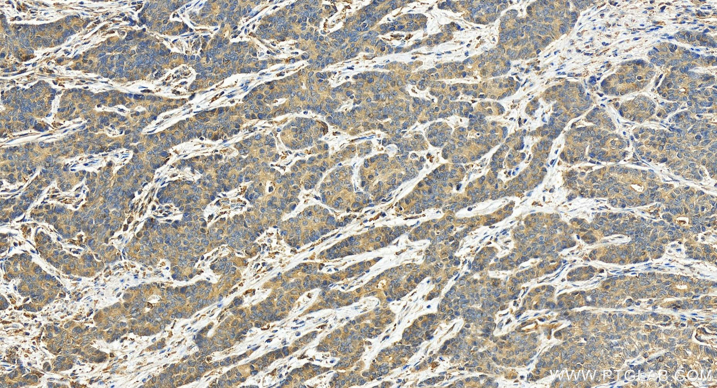 Immunohistochemistry (IHC) staining of human stomach cancer tissue using ACTR3B Polyclonal antibody (17022-1-AP)