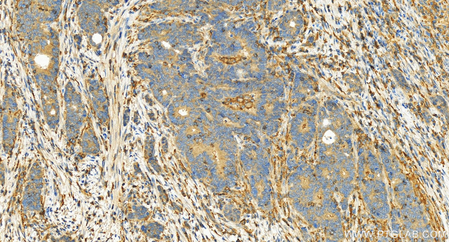 Immunohistochemistry (IHC) staining of human stomach cancer tissue using ACTR3B Polyclonal antibody (17022-1-AP)