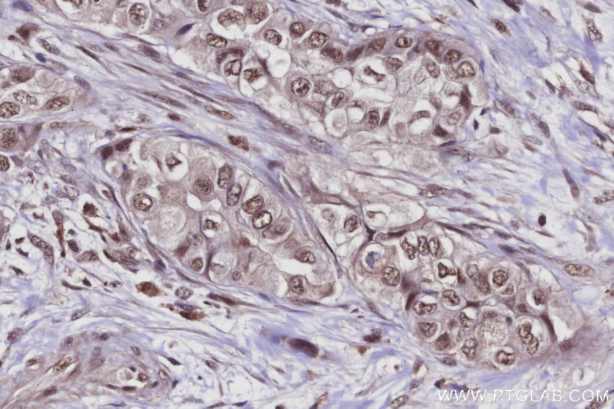 Immunohistochemistry (IHC) staining of human pancreas cancer tissue using Arp5/ACTR5 Polyclonal antibody (21505-1-AP)