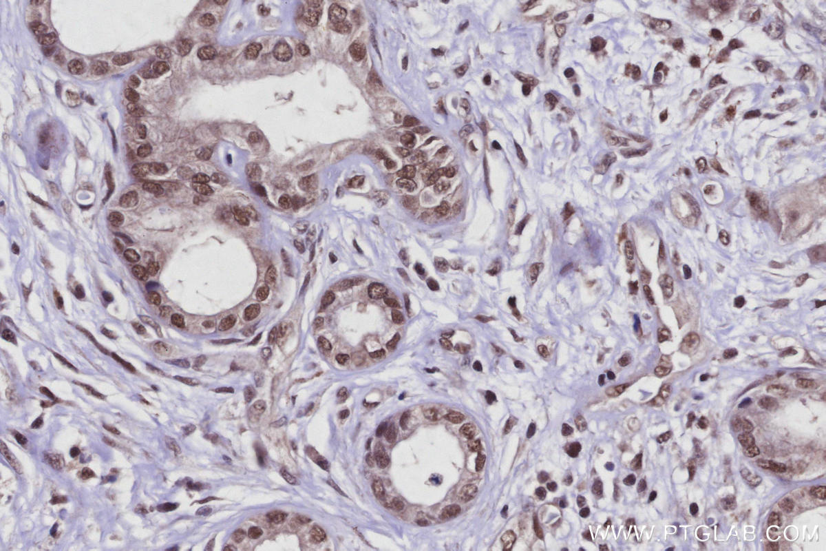 Immunohistochemistry (IHC) staining of human pancreas cancer tissue using Arp5/ACTR5 Polyclonal antibody (21505-1-AP)