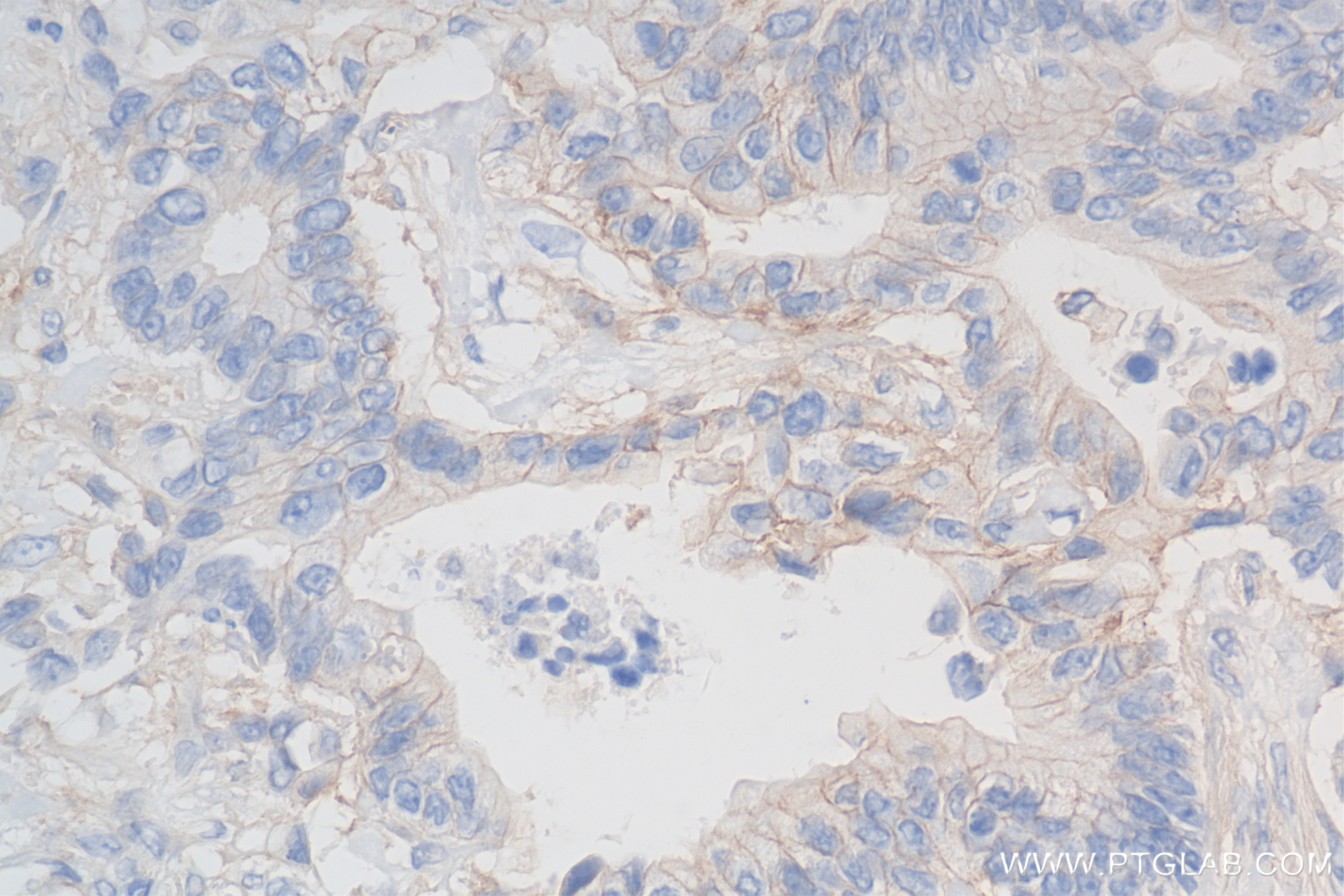 Immunohistochemistry (IHC) staining of human rectal cancer tissue using ADAM17 Recombinant antibody (84292-4-RR)