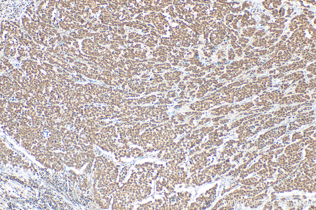 Immunohistochemistry (IHC) staining of human colon cancer tissue using ADAR1 Polyclonal antibody (14330-1-AP)