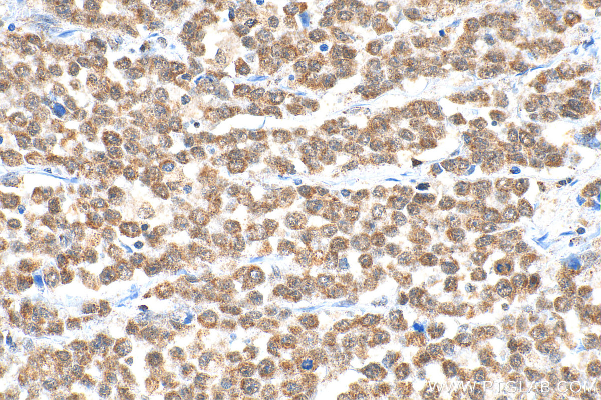 Immunohistochemistry (IHC) staining of human colon cancer tissue using ADAR1 Polyclonal antibody (14330-1-AP)