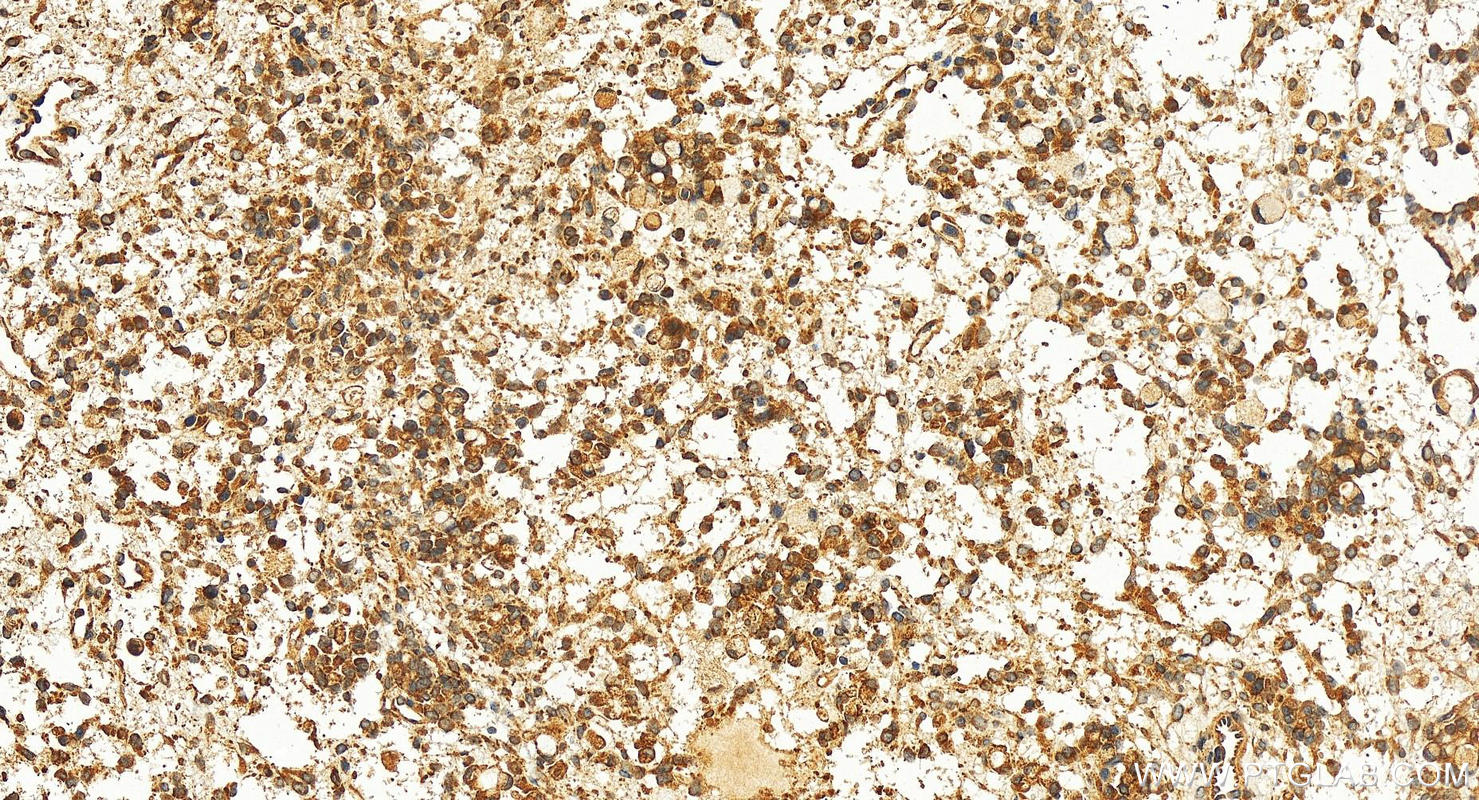 Immunohistochemistry (IHC) staining of human ovary cancer tissue using ADCK5 Polyclonal antibody (17579-1-AP)