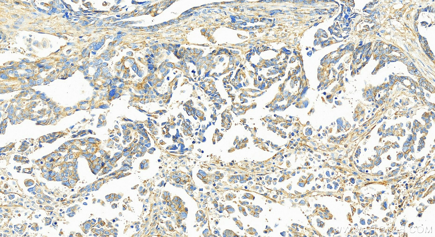 Immunohistochemistry (IHC) staining of human ovary cancer tissue using Alpha Adducin Polyclonal antibody (10791-1-AP)