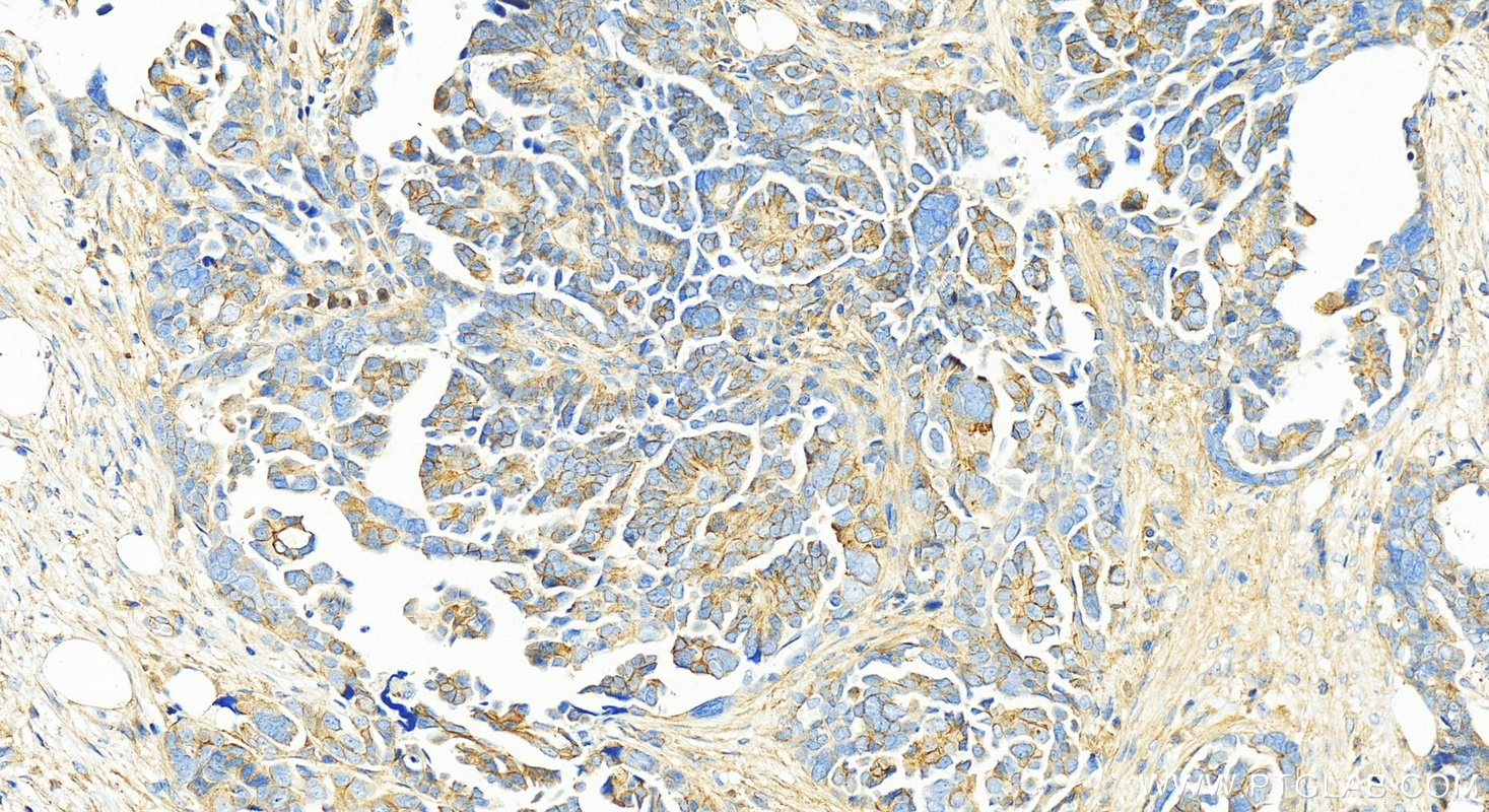 Immunohistochemistry (IHC) staining of human ovary cancer tissue using Alpha Adducin Polyclonal antibody (10791-1-AP)