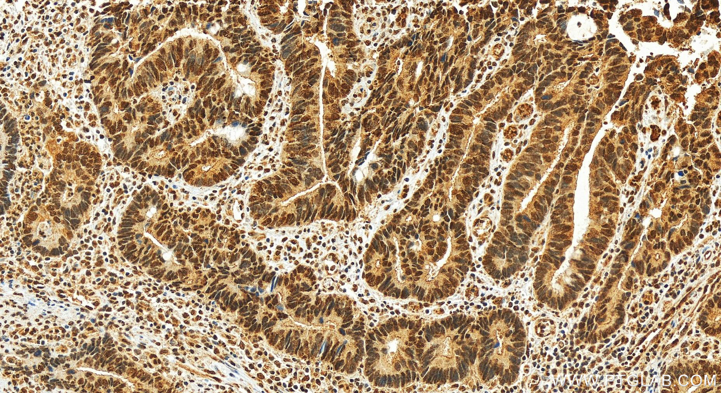 Immunohistochemistry (IHC) staining of human rectal cancer tissue using AEG-1/MTDH Monoclonal antibody (68592-1-Ig)